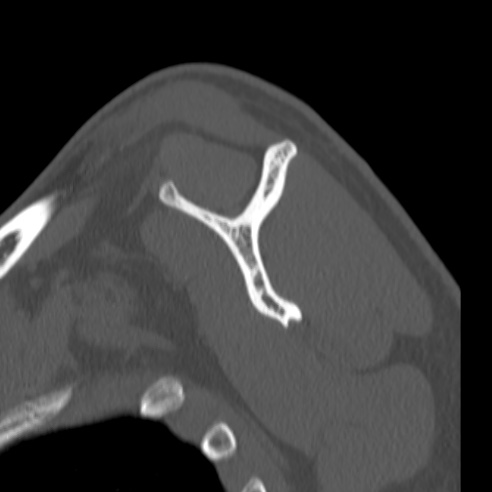 Bankart lesion (Radiopaedia 57256-64185 Sagittal bone window 39).jpg
