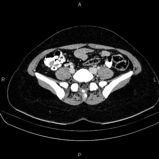 File:Bartholin gland cyst (Radiopaedia 62635-70930 Axial Post contrast 10).jpg