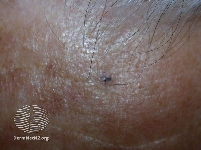 File:Basal cell carcinoma affecting the face (DermNet NZ lesions-bcc-face-0912).jpg