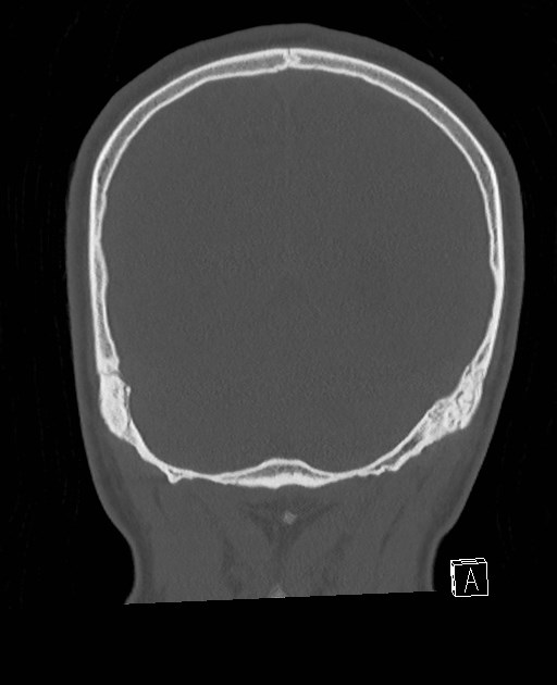 Base of skull fracture with bilateral Le Fort fractures (Radiopaedia 47094-51638 Coronal bone window 23).jpg