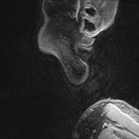 Base of tongue squamous cell carcinoma (Radiopaedia 31174-31884 F 174).jpg