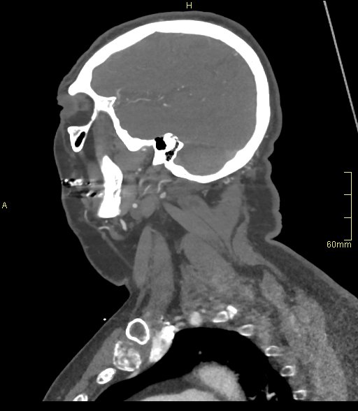 Basilar artery aneurysm (Radiopaedia 56261-62932 C 59).jpg