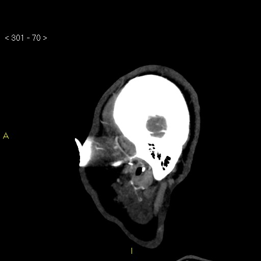 File:Basilar artery thrombosis (Radiopaedia 16260-15944 C 64).jpg