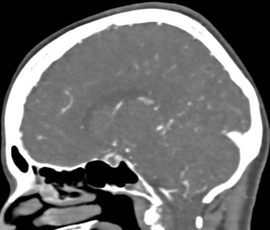 Basilar tip aneurysm with coiling (Radiopaedia 53912-60086 C 57).jpg