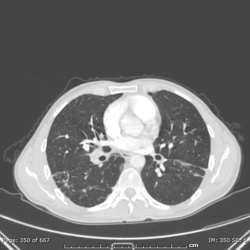 File:Behçet disease (Radiopaedia 44247-47889 Axial lung window 46).jpg