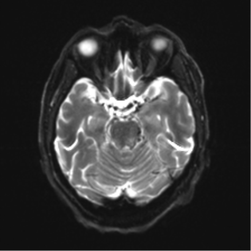 Behavioral variant frontotemporal dementia and late onset schizophrenia (Radiopaedia 52197-58083 Axial DTI Trace W 9).png
