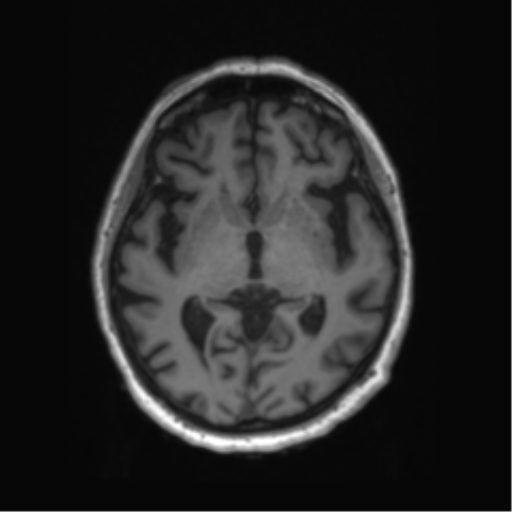 Behavioral variant frontotemporal dementia and late onset schizophrenia (Radiopaedia 52197-58083 Axial T1 55).png