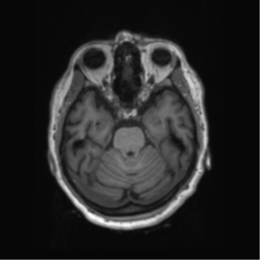 File:Behavioral variant frontotemporal dementia and late onset schizophrenia (Radiopaedia 52197-58083 Axial T1 74).png