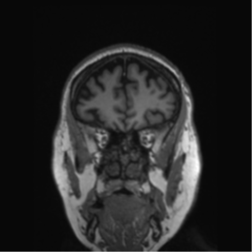 Behavioral variant frontotemporal dementia and late onset schizophrenia (Radiopaedia 52197-58083 Coronal T1 71).png