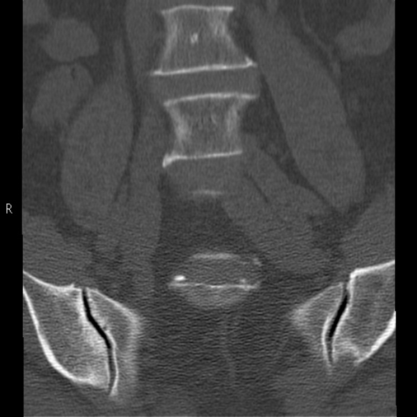 Bertolotti syndrome (Radiopaedia 24864-25128 Coronal bone window 10).jpg