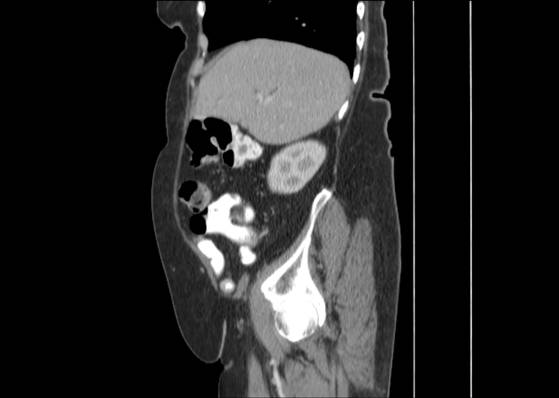 File:Bicameral celiacomesenteric aneurysm (Radiopaedia 55766-62327 B 16).jpg