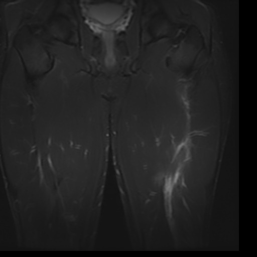 File:Biceps femoris strain injury (Radiopaedia 16800-16515 Coronal STIR 8).jpg