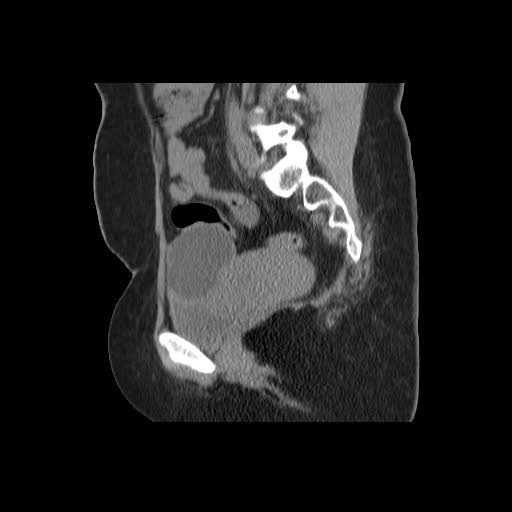 File:Bicornuate uterus- on MRI (Radiopaedia 49206-54296 A 13).jpg