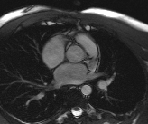 File:Bicuspid aortic valve with aortic coarctation (Radiopaedia 29895-30410 Oblique SSFP Cine 8).jpg