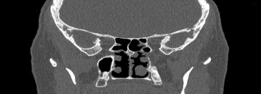 Bilateral Ectopic Infraorbital Nerves (Radiopaedia 49006-54084 Coronal bone window 59).jpg