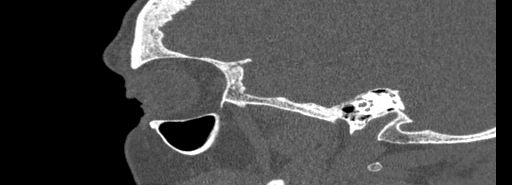 Bilateral Ectopic Infraorbital Nerves (Radiopaedia 49006-54084 Sagittal bone window 46).jpg