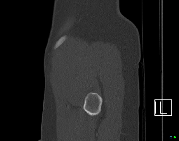 Bilateral acetabular fractures (Radiopaedia 79272-92308 Sagittal bone window 85).jpg