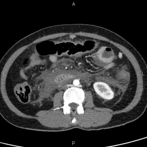 Bilateral adrenal gland hyperenhancement in pancreatitis (Radiopaedia 86642-102753 B 75).jpg