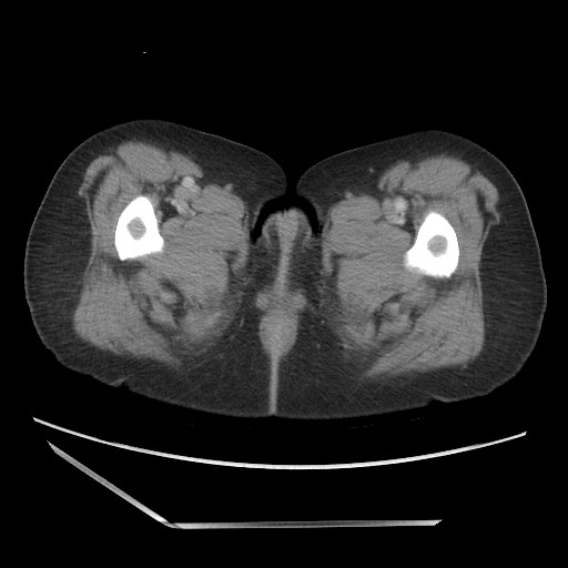 Bilateral adrenal granulocytic sarcomas (chloromas) (Radiopaedia 78375-91007 A 134).jpg