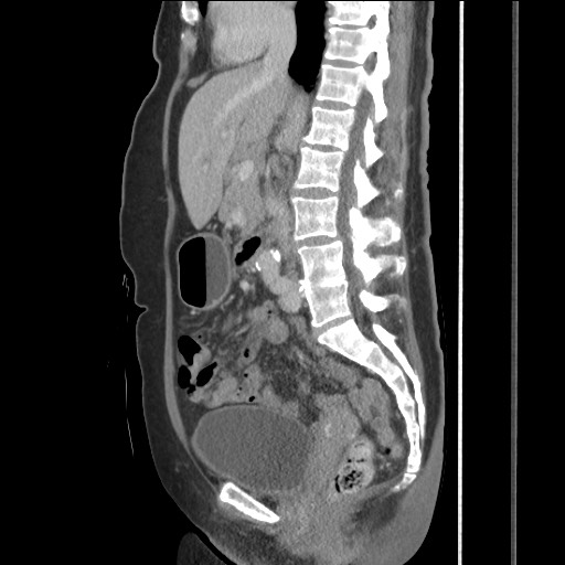 Bilateral adrenal granulocytic sarcomas (chloromas) (Radiopaedia 78375-91007 C 70).jpg