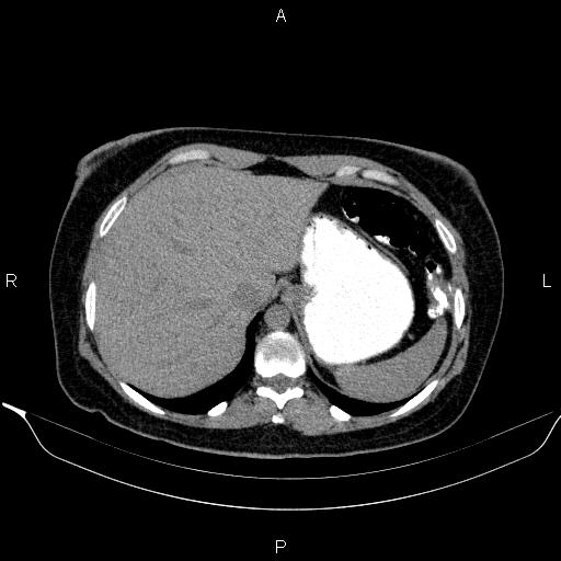 Bilateral adrenal myelolipoma (Radiopaedia 63058-71535 Axial non-contrast 27).jpg