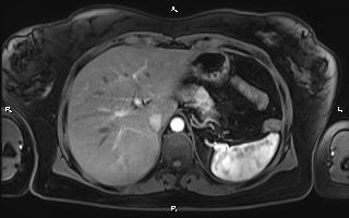 Bilateral adrenal myelolipoma (Radiopaedia 63058-71537 Axial T1 C+ fat sat 26).jpg