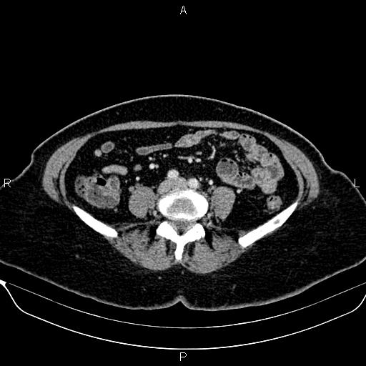 Bilateral benign adrenal adenomas (Radiopaedia 86912-103124 B 70).jpg