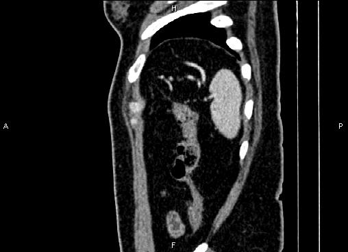 Bilateral benign adrenal adenomas (Radiopaedia 86912-103124 E 90).jpg