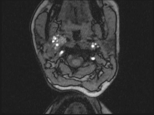 Bilateral carotid body tumors and right glomus jugulare tumor (Radiopaedia 20024-20060 Axial MRA 274).jpg