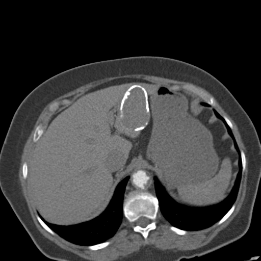 File:Bilateral delayed nephrogram from renal artery stenosis (Radiopaedia 47681-52362 A 11).png