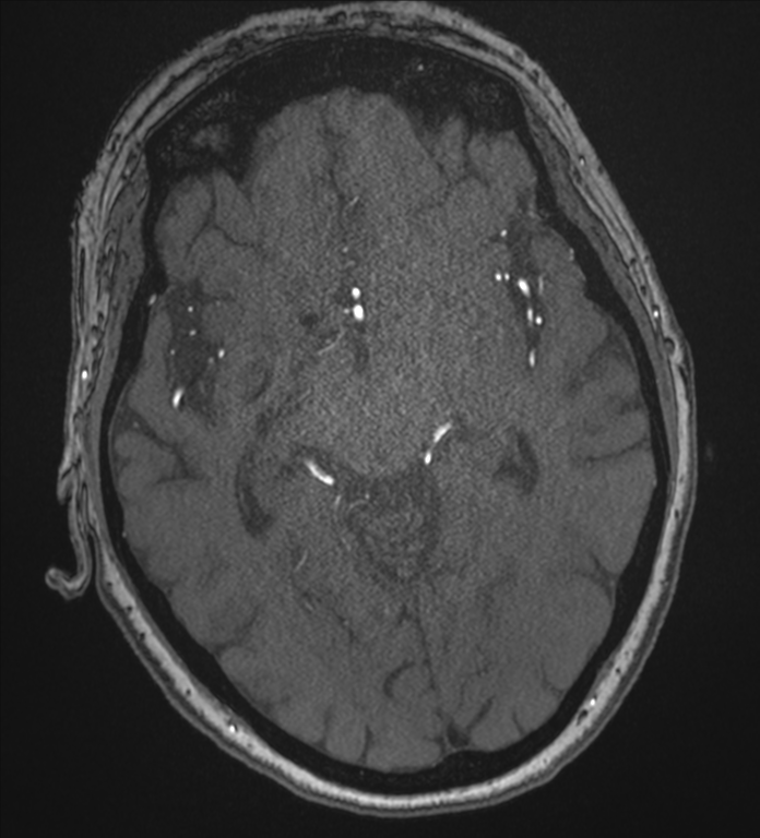 Bilateral fetal posterior communicating arteries (Radiopaedia 41286-44102 Axial MRA 95).png
