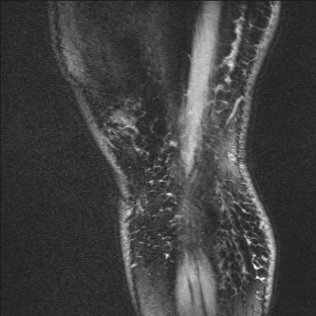 Bilateral focal pigmented villonodular synovitis (Radiopaedia 67643-77073 Sagittal T1 vibe 3).jpg