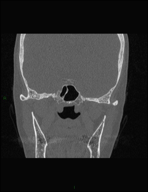 Bilateral frontal mucoceles (Radiopaedia 82352-96454 Coronal 241).jpg