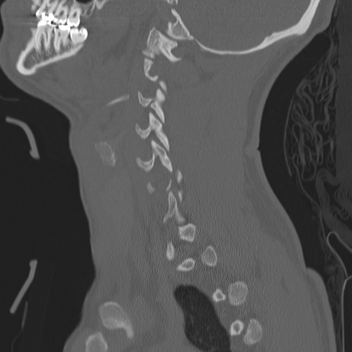 Bilateral locked facets (Radiopaedia 33850-35016 Sagittal bone window 7).png