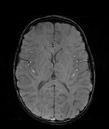 Bilateral mesial temporal polymicrogyria (Radiopaedia 76456-88181 Axial SWI 37).jpg