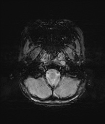 Bilateral mesial temporal polymicrogyria (Radiopaedia 76456-88181 Axial SWI 4).jpg