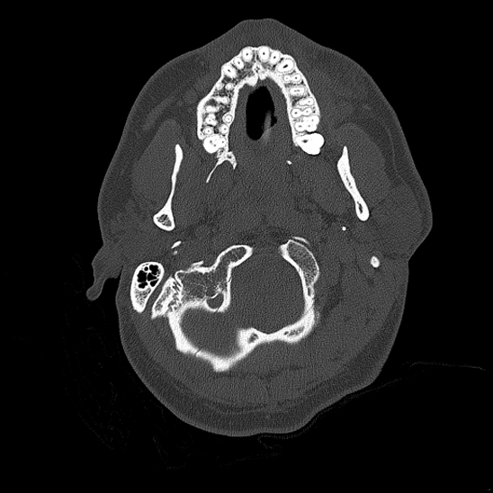 Bilateral occipital condyle fracture (type 2) (Radiopaedia 87675-104089 Axial bone thins 16).jpg