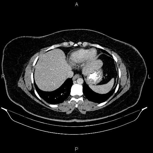 Bilateral ovarian dermoid cysts (Radiopaedia 85785-101603 A 14).jpg