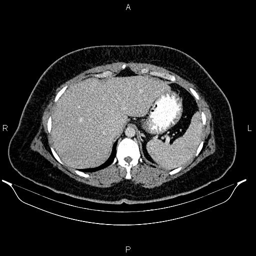 Bilateral ovarian dermoid cysts (Radiopaedia 85785-101603 A 23).jpg