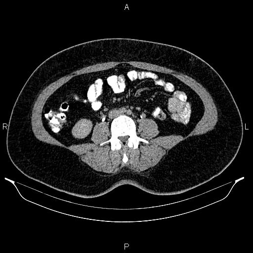 File:Bilateral ovarian dermoid cysts (Radiopaedia 85785-101603 Axial C+ delayed 42).jpg