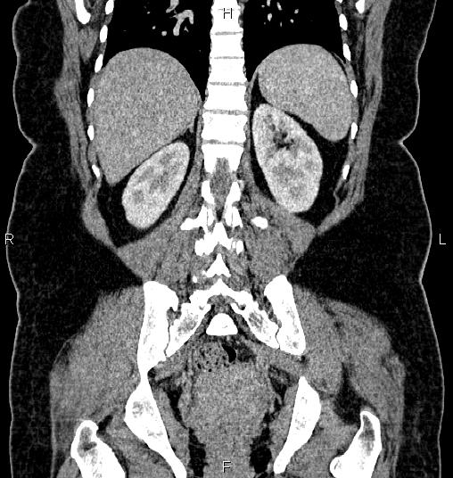 Bilateral ovarian dermoid cysts (Radiopaedia 85785-101603 C 43).jpg