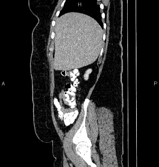 Bilateral ovarian dermoid cysts (Radiopaedia 85785-101603 D 13).jpg