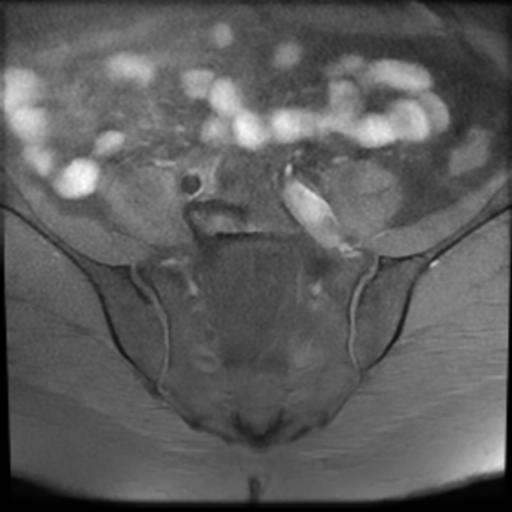 File:Bilateral ovarian dermoid cysts (Radiopaedia 90152-107338 Axial T1 fat sat 4).jpg