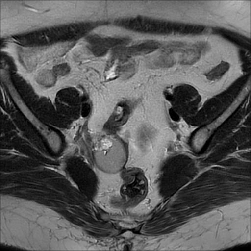 File:Bilateral ovarian dermoid cysts (Radiopaedia 90152-107338 Axial T2 8).jpg