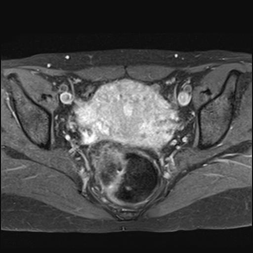 File:Bilateral ovarian endometriomas (Radiopaedia 87085-103347 Axial T1 C+ fat sat 12).jpg