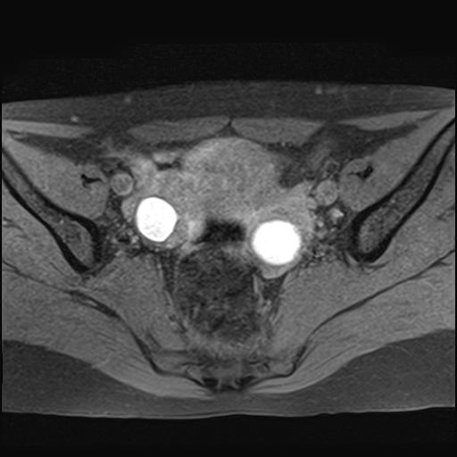 File:Bilateral ovarian endometriomas (Radiopaedia 87085-103347 Axial T1 fat sat 9).jpg