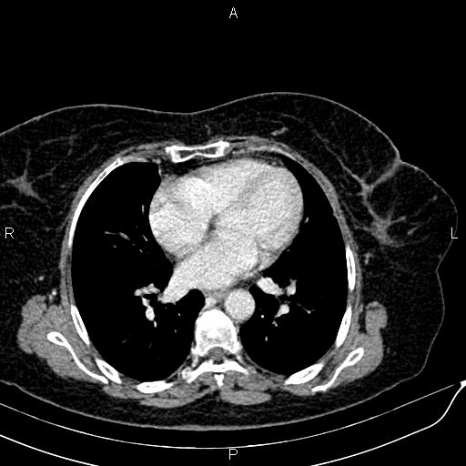 Bilateral ovarian serous cystadenocarcinoma (Radiopaedia 86062-101989 B 3).jpg