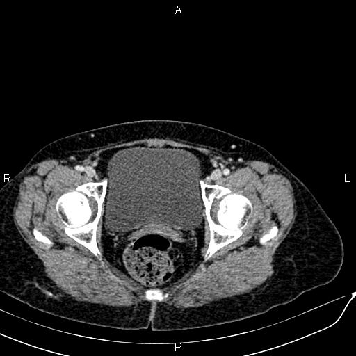 Bilateral ovarian serous cystadenocarcinoma (Radiopaedia 86062-101989 B 96).jpg