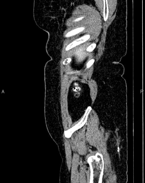 Bilateral ovarian serous cystadenocarcinoma (Radiopaedia 86062-101989 E 4).jpg