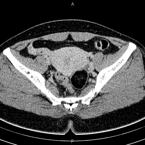 Bilateral ovarian teratoma (Radiopaedia 83131-97503 B 38).jpg